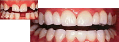 Periodontal Disease Mesa