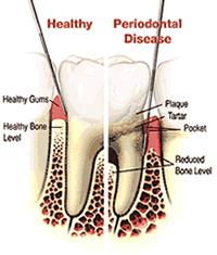 Periodontal Disease Gilbert